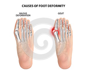Causes of foot deformity.